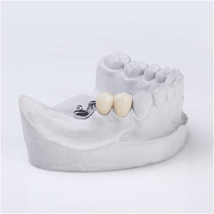 Precision Attachment || Smile Stones Dental Pvt Ltd